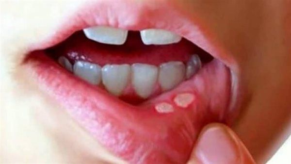 دراسة جديدة تقدم نظرة أعمق للعلاقة بين بكتيريا الفم الشائعة والأمراض المهددة للحياة.. التفاصيل الكاملة