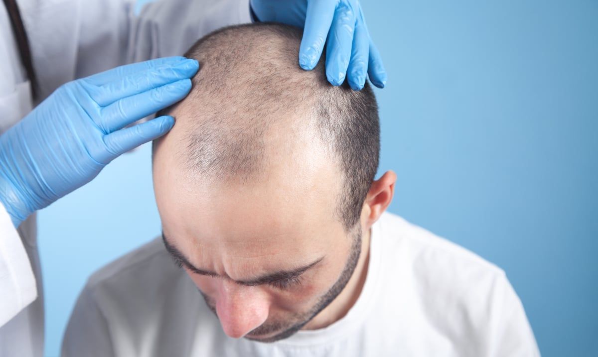 الكشف عن نظام لزراعة الشعر بمساعدة الروبوتات