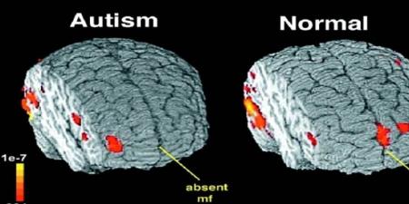 علماء يكتشفون علاقة بين بنية الدماغ ومرض التوحد لدى الأطفال - الخليج الان
